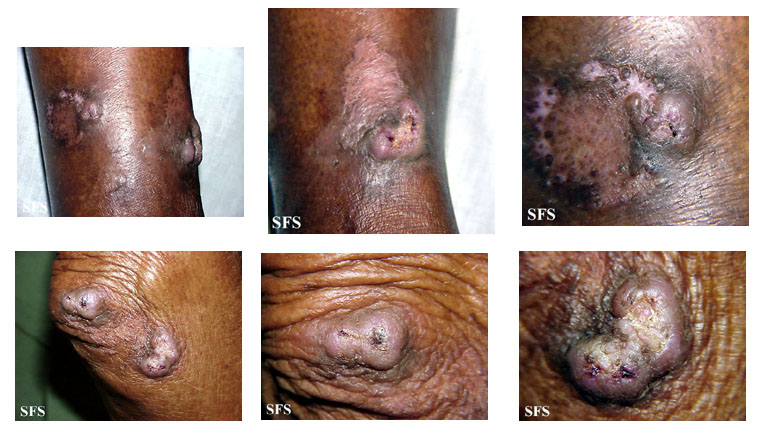 File:Keratoacanthoma (Dermatology Atlas 28).jpg