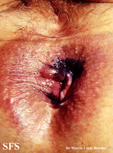 File:Melanoma (Dermatology Atlas 5).jpg