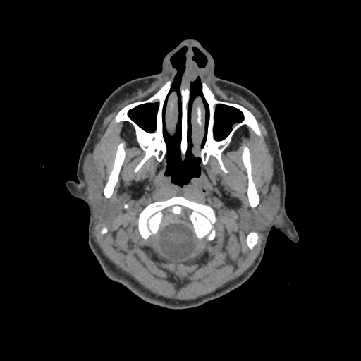 Nasal pyogenic granuloma (lobular capillary hemangioma) (Radiopaedia 85536-101244 Axial non-contrast 14).jpg