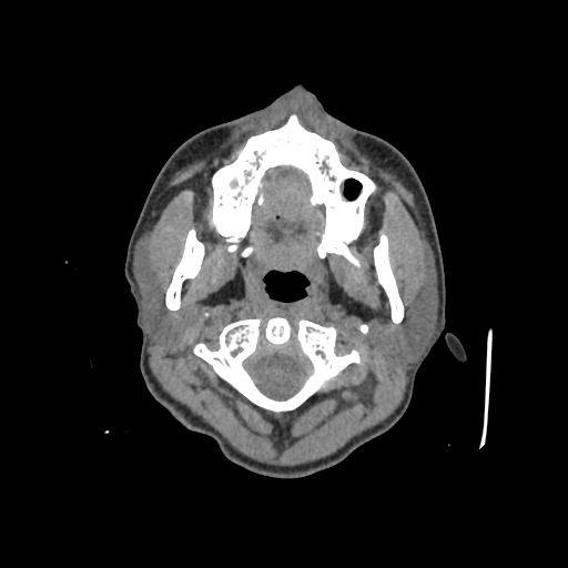 Nasal pyogenic granuloma (lobular capillary hemangioma) (Radiopaedia 85536-101244 Axial non-contrast 2).jpg