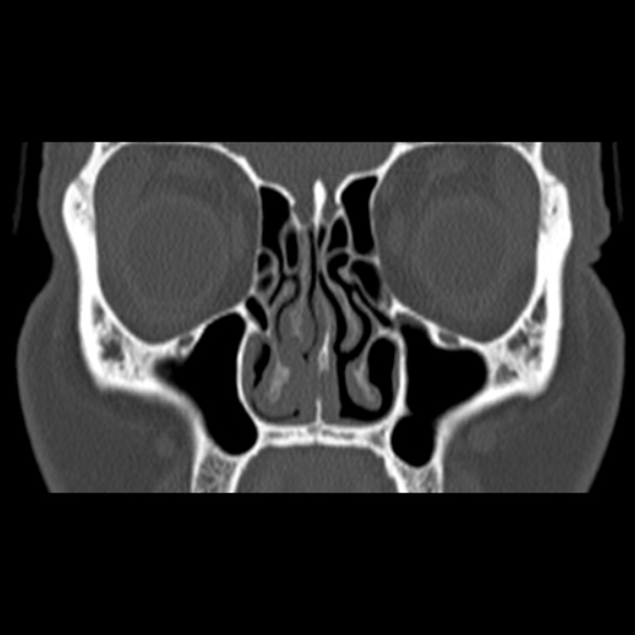 Nasal septal perforation (Radiopaedia 25030-25289 Coronal bone window 28).jpg