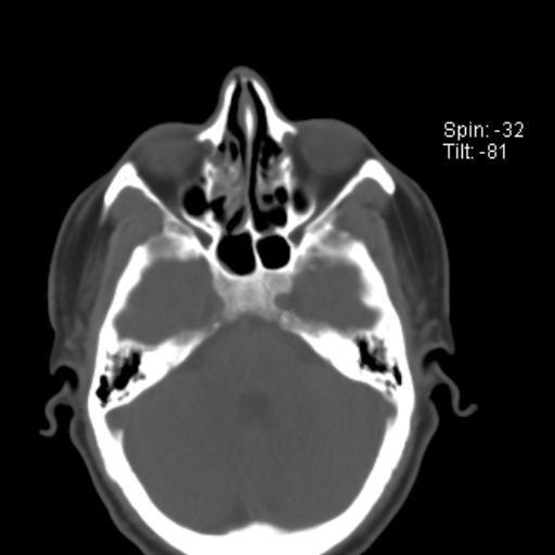 File:Nasolabial cyst (Radiopaedia 28401-28650 Axial bone window 5).jpg