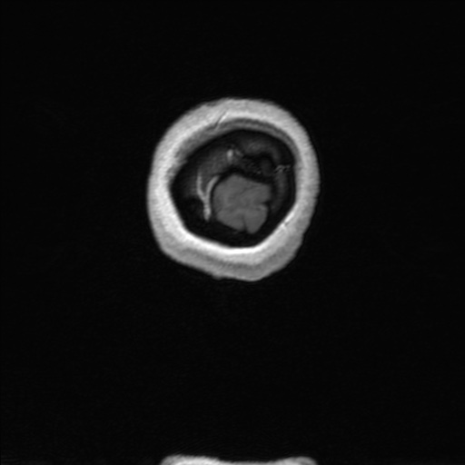 Nasopharyngeal carcinoma (T1 N3a) with complete response (Radiopaedia 61357-69619 Coronal 3D volume 191).jpg