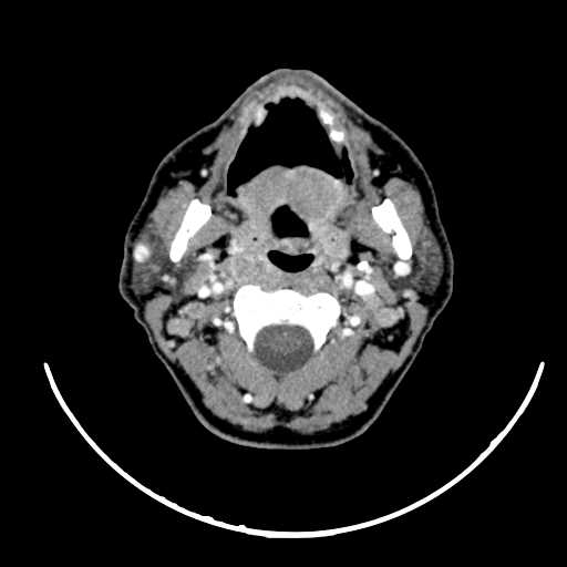 File:Nasopharyngeal carcinoma - infiltrating the clivus (Radiopaedia 62583-70875 Axial Post contrast 27).jpg