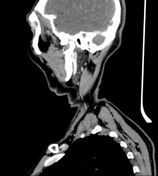 File:Nasopharyngeal carcinoma - infiltrating the clivus (Radiopaedia 62583-70875 C 44).jpg