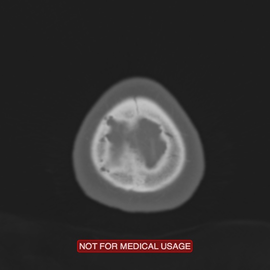 Nasopharyngeal carcinoma recurrence - skull base destruction (Radiopaedia 29107-29490 Axial bone window 7).jpg