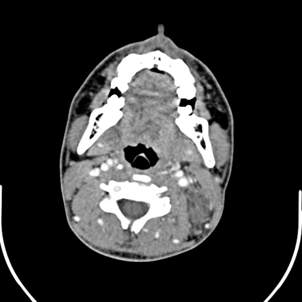 Nasopharyngeal carcinoma with skull base invasion (Radiopaedia 53415-59705 A 103).jpg