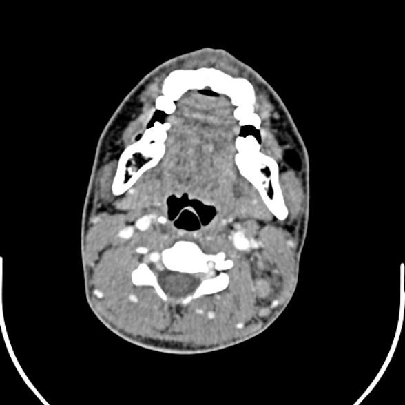 Nasopharyngeal carcinoma with skull base invasion (Radiopaedia 53415-59705 A 108).jpg