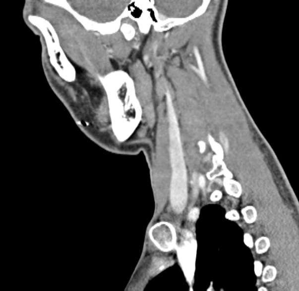 File:Nasopharyngeal carcinoma with skull base invasion (Radiopaedia 53415-59705 C 17).jpg
