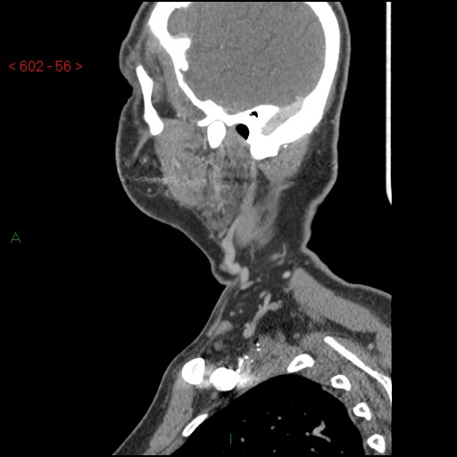 File:Nasopharyngeal lymphoma (Radiopaedia 54235-60433 B 2).jpg