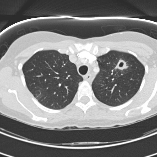 Necrobiotic pulmonary nodules - Crohn disease (Radiopaedia 20723-20631 Axial lung window 35).jpg