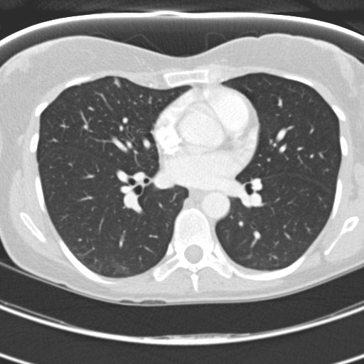Necrobiotic pulmonary nodules - Crohn disease (Radiopaedia 20723-20631 Axial lung window 77).jpg