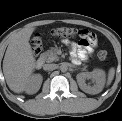 File:Necrotizing pancreatitis with acute necrotic collection (Radiopaedia 14470-14417 Axial non-contrast 15).jpg