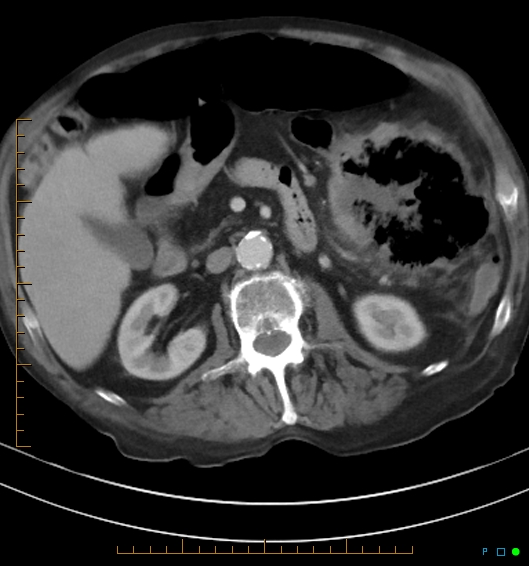 Necrotzing fasciitis due to a perforated adenocarcinoma of the splenic flexure (Radiopaedia 46930-51455 A 30).jpg