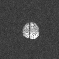 File:Neonatal hypoxic-ischemic encephalopathy (Radiopaedia 41406-44277 Axial DWI 3).jpg