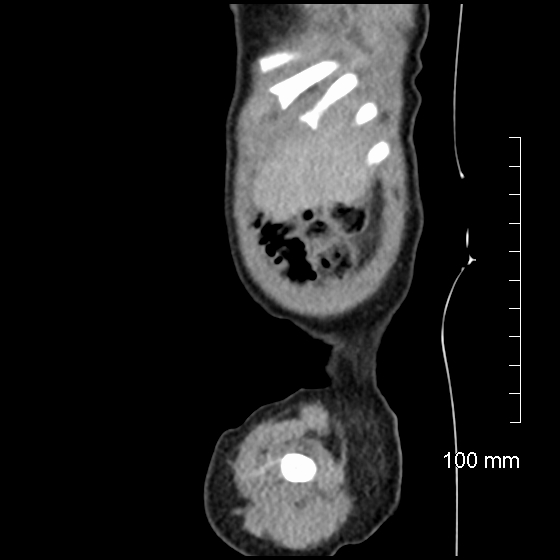File:Neonatal neuroblastoma (Radiopaedia 56651-63438 C 16).jpg