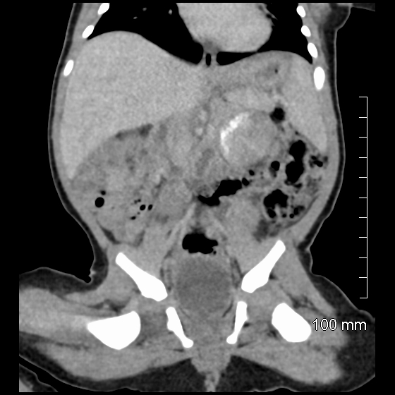 File:Neonatal neuroblastoma (Radiopaedia 56651-63438 Coronal non-contrast 28).jpg