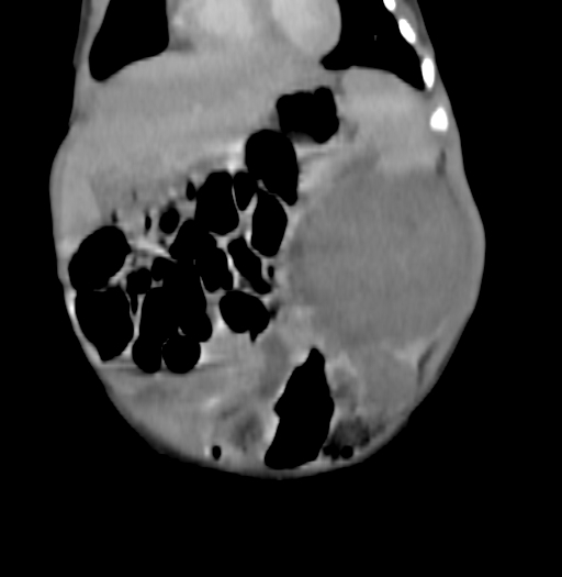 Nephroblastomatosis (Radiopaedia 71294-81607 B 108).jpg