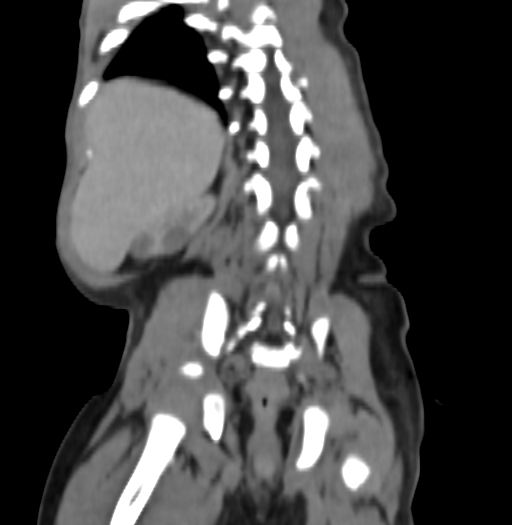 Nephroblastomatosis (Radiopaedia 71294-81607 B 277).jpg