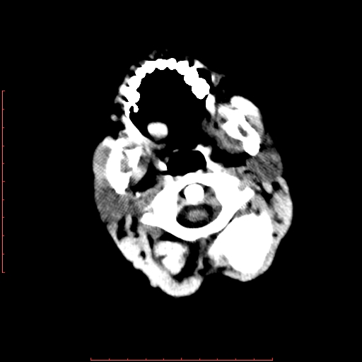 File:Neuroblastoma skull metastasis (Radiopaedia 56053-62683 Axial non-contrast 2).jpg
