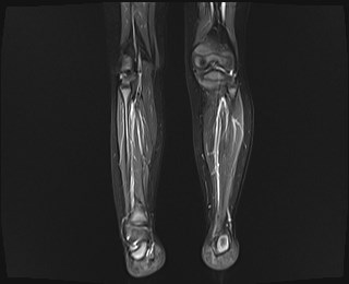 File:Neuroblastoma with bone metastases (Radiopaedia 67080-76414 B 11).jpg