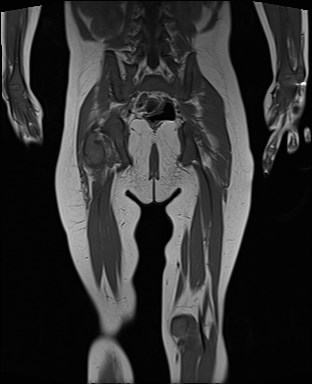 File:Neuroblastoma with bone metastases (Radiopaedia 67080-76414 Coronal T1 18).jpg