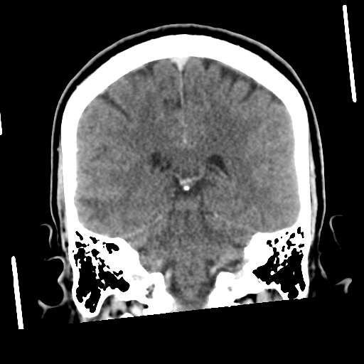 Neurocysticercosis - granular nodular (Radiopaedia 42786-45957 Coronal C+ 42).png