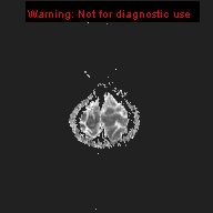 File:Neurofibromatosis type 1 with optic nerve glioma (Radiopaedia 16288-15965 Axial ADC 1).jpg