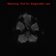 File:Neurofibromatosis type 1 with optic nerve glioma (Radiopaedia 16288-15965 Axial DWI 66).jpg