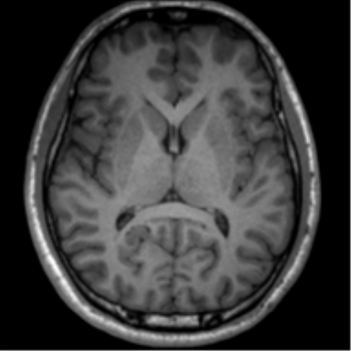 File:Neurofibromatosis type 2 (Radiopaedia 44936-48838 Axial T1 77).png