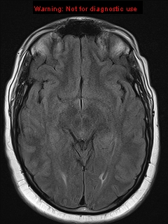 File:Neuroglial cyst (Radiopaedia 10713-11184 Axial FLAIR 13).jpg