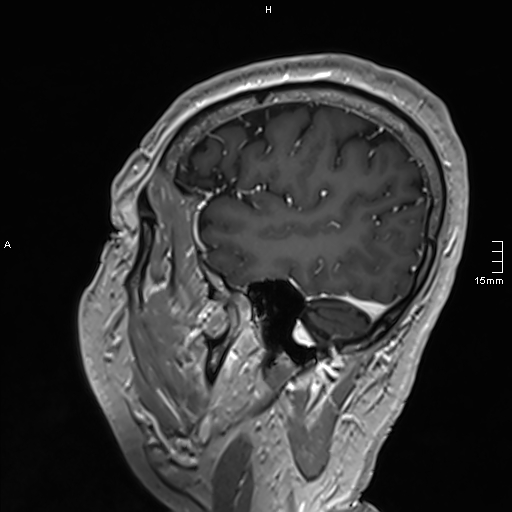 Neurosarcoidosis - involvement of the mesial temporal lobes (Radiopaedia 67429-76820 Sagittal T1 C+ 135).jpg