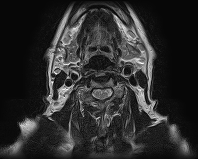 File:Non-Hodgkin lymphoma - parotid gland (Radiopaedia 71531-81890 Axial T2 5).jpg