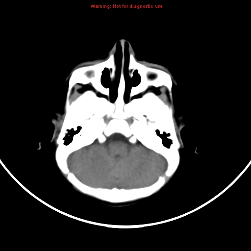 File:Non-accidental injury - bilateral subdural with acute blood (Radiopaedia 10236-10765 Axial non-contrast 4).jpg