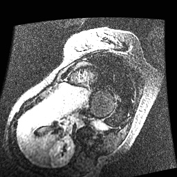 File:Non-compaction of the left ventricle (Radiopaedia 38868-41062 E 3).jpg