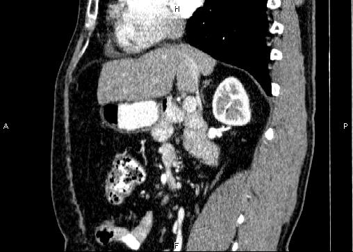Non-syndromic pancreatic endocrine tumor (Radiopaedia 86958-103178 E 43).jpg