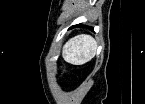Non-syndromic pancreatic endocrine tumor (Radiopaedia 86958-103178 E 98).jpg