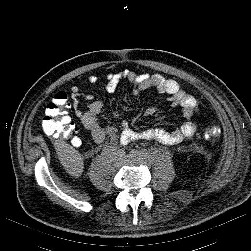 File:Non Hodgkin lymphoma in a patient with ankylosing spondylitis (Radiopaedia 84323-99621 Axial non-contrast 44).jpg