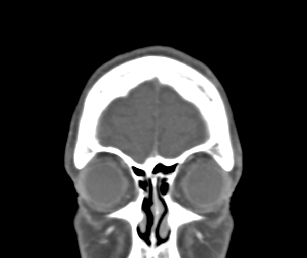 File:Normal CTA head (Radiopaedia 40801-43464 B 15).png