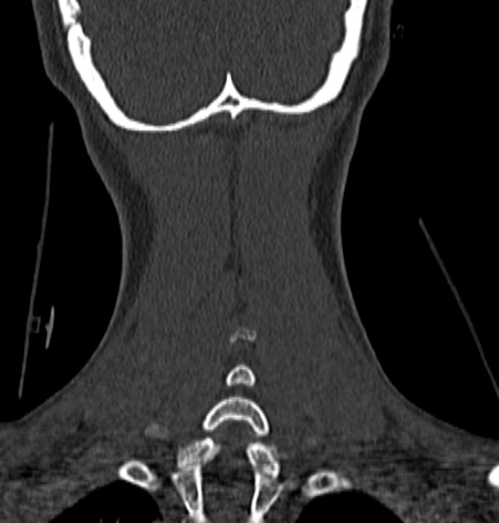 File:Normal CT cervical spine - 12-year-old (Radiopaedia 55352-61775 Coronal bone window 198).jpg