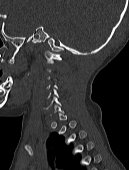 File:Normal CT cervical spine - pediatric (Radiopaedia 52549-58462 Sagittal bone window 23).jpg