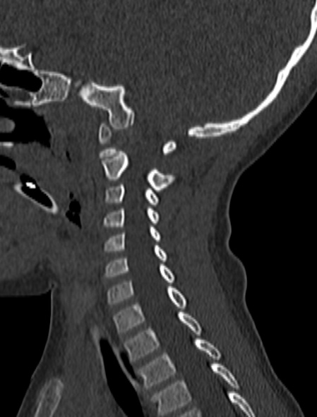 Normal CT cervical spine - pediatric (Radiopaedia 52549-58462 Sagittal bone window 73).jpg