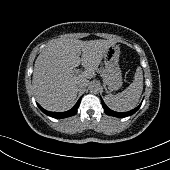 Normal CT chest- adult female (Radiopaedia 52522-58428 Axial non-contrast 124).jpg