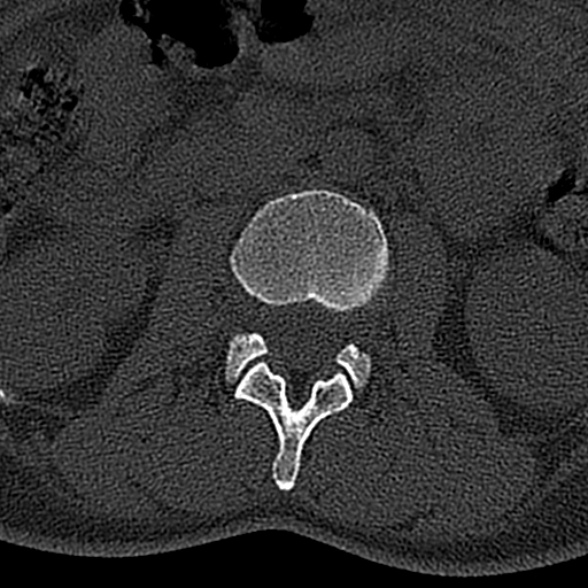 File:Normal CT lumbar spine (Radiopaedia 53981-60118 Axial bone window 30).jpg