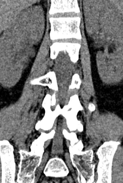 Normal CT lumbar spine (Radiopaedia 53981-60118 F 54).jpg