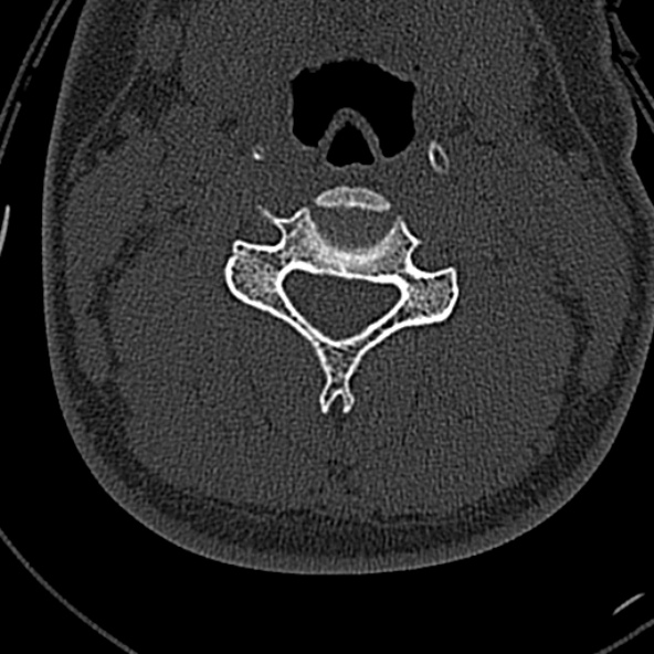 Normal CT of the cervical spine (Radiopaedia 53322-59305 Axial bone window 128).jpg
