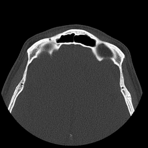 Normal CT paranasal sinuses (Radiopaedia 42286-45390 Axial bone window 27).jpg