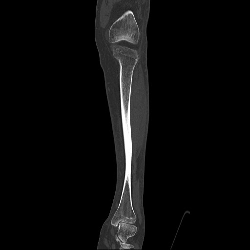 Normal CT tibia and fibula (Radiopaedia 51195-56848 Coronal non-contrast 27).jpg