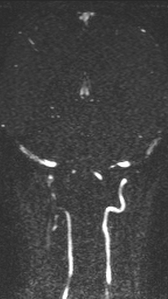 Normal MRI brain with MRV- teenager (Radiopaedia 49425-54553 Coronal MRV 160).jpg
