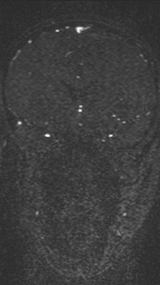 Normal MRI brain with MRV- teenager (Radiopaedia 49425-54553 Coronal MRV 96).jpg